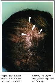 Cherry angiomas are known to increase with age, specifically after 40 years old. Cherry Hemangioma In The Scalp