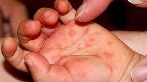 The cdc note that most people, regardless of. Phuket Marks Third Highest Hand Foot And Mouth Disease Infection Rate In The Country