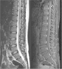 Low thoracic and lumbar spine MRI showing a hyperintense lesion in the... |  Download Scientific Diagram