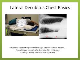 The vertical gradient in the lateral decubitus position is less than that in the upright position (fig. Positioning Considerations For Imaging Of The Chest And Thorax Ppt Download