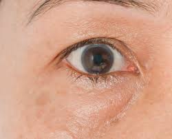 You'll find many swollen eyes from crying remedies. Puffy Eyes Overview And More