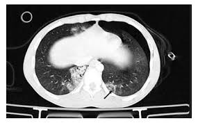 Image result for Pulmonary Contusion