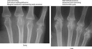 Image result for XRay Changes in Rheumatic Conditions