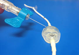 Walter S Hydrocephalus Education Blog What Is Hydrocephalus Part 2 Of 2