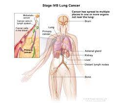 Maybe you would like to learn more about one of these? Definition Of Stage Iv Non Small Cell Lung Cancer Nci Dictionary Of Cancer Terms National Cancer Institute