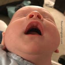 Why is the roof of my baby's mouth missing? What Are Suck Blisters Flourishing Tots