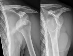 Fibers from the coracohumeral and glenohumeral ligaments were found concentrated in a plane between the capsule and the tendons of. Shoulder Dislocation Amboss