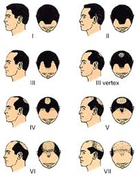 If you feel like your jawbone is a little rounder, facial hair is great for sculpting a more square shape. Male Pattern Baldness The Insight To Your Curly Hair The Lifestyle Blog For Modern Men Their Hair By Curly Rogelio