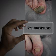 Image result for Onychogryphosis feet