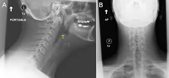 Image result for Epiglottitis