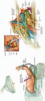 Surgical Treatment Of Thoracic Outlet Syndrome A Randomized Trial Comparing Two Operations In Journal Of Neurosurgery Spine Volume 3 Issue 5 2005