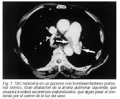 Tromboembolismo pulmonar clasificación y recursos externos. Diagnostico Con Tac Helicoidal Y Ecocardiografia De La Hipertension Pulmonar Por Tromboembolismo Pulmonar Cronico