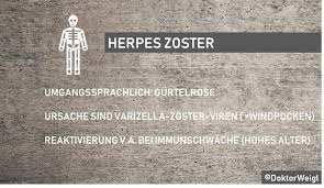 Die gürtelrose kann am bein auftreten und zeigt normalerweise die typischen symptome der erkrankung. Doktorweigl Erklart Gurtelrose Herpes Zoster Eine Unangenehme Folge Der Windpocken