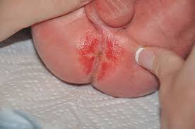 Image result for newborn diaper rash