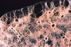 The fixed lung volume (airspace plus tissue) was measured by water displacement. Parenchyma Wikipedia