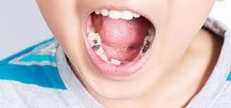 Wann wird der zahn gezogen? Wann Mussen Milchzahne Vom Zahnarzt Gezogen Werden 360 Milchzahn
