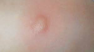 Image result for Urticaria pigmentosa children