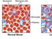 Leukemia: Symptoms, Signs, Causes, Types & Treatment