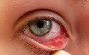 Das geschieht wenn sich der pickel durch bakterien entzündet. Gerstenkorn Am Auge Dise 5 Hausmittel Helfen Besser Gesund Leben Pink Eye Treatment Pinkeye Remedies Home Remedies For Pink Eye