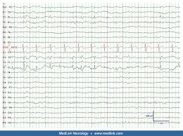 Baca manhwa komik dewasa bahasa indonesia. Eeg In Epilepsy Medlink Neurology