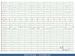 That man's epilepsy raw chapter 136. Eeg In Epilepsy Medlink Neurology