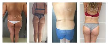 Lipofilling avant après, lipofilling prix, lipofilling mammaire avis, lipofilling raté, lipofilling poitrine, lipofilling mammaire prix france >>> dr zerbib. Lipofilling Fesses Tunisie Brazilian Butt Lift Injection Fessier