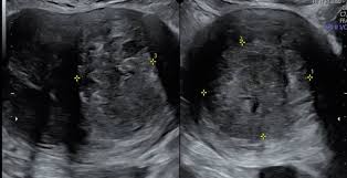 Image result for Leiomyosarcoma