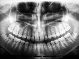 Do Wisdom Teeth Stitches Dissolve Or Fall Out Qigong Hub