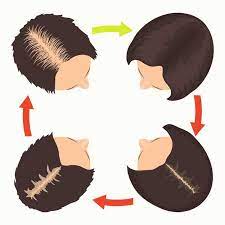 This is not a complete list of side effects and others may occur. 9 Things That Cause Hair Loss Masterpiece Skin Restoration