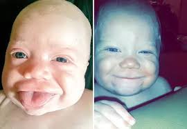 Baby Born With Tongue Twice As Big As Her Mouth Is Able To Smile After Op