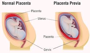 Common causes of discomforts during pregnancy include nausea and vomiting (morning sickness), fatigue, breast swelling and pain, hemorrhoids, stretch marks, mood swings, dizziness, migraines, tooth pain and bleeding gums, and pica. Spotting During Pregnancy Causes And Symptoms Styles At Life