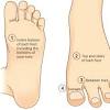 Squamous cell carcinoma is the most common form of cancer on the skin of the feet. 1
