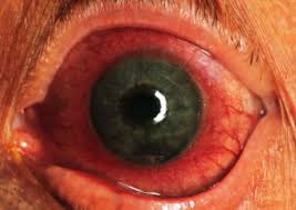 Image result for Ciliary Flush