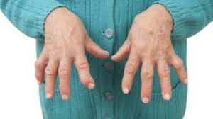 Rheumatoid Arthritis Symptoms And Treatments Colorado Pain Care