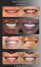 Many practices offer a monthly payment less than $100/month. Invisalign Nyc Top Invisalign Dentist In New York City