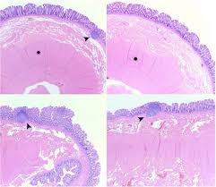 Tubular Colonic Duplication In An Adult Patient With Long Standing History Of Constipation And Tenesmus