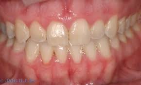 In gingivitis, the gums become red, swollen and can bleed easily. Tartar Or Calculus On Teeth Why Do I Get It Julie M Gillis Dds