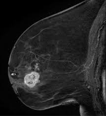 You can have breast cancer without feeling anything out of the ordinary. Breast Mri State Of The Art Radiology