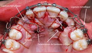 The open eruption technique may be performed in two different ways, as described below. Surgical Technique Dr Sylvain Chamberland Orthodontiste