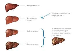 Lechenie Hronicheskogo Gepatita V Preparatom Baraclude