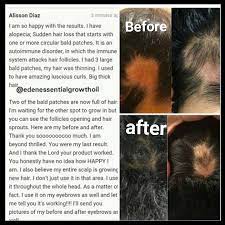 Hair+serum modelleri, hair+serum özellikleri ve markaları en uygun fiyatları ile gittigidiyor'da. Eden Kingdom Essential Super Fast Hair Growth Bald Spots Restored Order Formula D Hair Regrowth Serum 100 Natural 100 Fruit Oils 100 Herbs 100 Essential Oils No Chemicals Hand Made World Wide