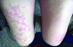 Maybe you would like to learn more about one of these? Skin Manifestations Are Emerging In The Coronavirus Pandemic Mdedge Dermatology