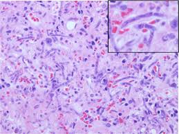 This infection is caused byaspergillus, a hyaline mold that is ubiquitous. Invasive Fungal Orbitorhinocerebral Mucormycosis Eyerounds Org Ophthalmology The University Of Iowa