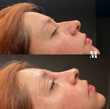 𝑳𝒊𝒒𝒖𝒊𝒅 𝑹𝒉𝒊𝒏𝒐𝒑𝒍𝒂𝒔𝒕𝒚