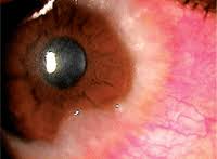 Image result for Vernal Conjunctivitis