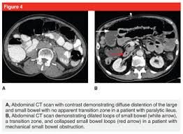 Image result for Adynamic Ileus