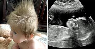 The number of ultrasounds you get during a pregnancy can vary from state to state, and even with different doctors. Baby S Quiff Was So Huge It Showed Up In The Ultrasound Metro News