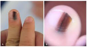 Image result for Acral lentiginous melanoma nail