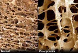 Acesta stabileste un plan de tratament si anume : Osteoporoza Leacuri Din Plante