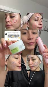 Crema para eliminar granitos: Respuesta a Cosrx.